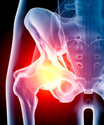 استئوآرتریت (Osteoarthritis)